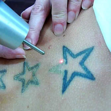 Dermatology-Laser-Tattoo